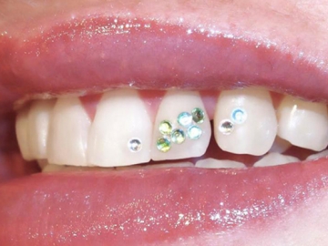 Sempat Tren di Era 90an, Tooth Gem Kembali Diminati Orang