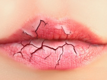 Bibir Kering Saat Puasa? Atasi dengan 5 Cara Ini