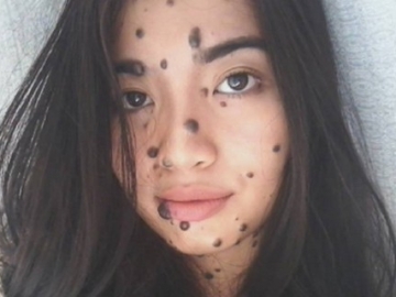 Punya Tahi Lalat di Sekujur Tubuh, Gadis Ini Pede Ikut Ajang Miss Universe 