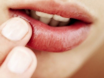 5 Cara Cepat Obati Sariawan Secara Alami