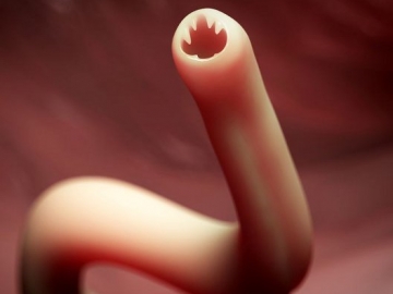 Cacing Tambang 'Menghuni' Kaki Remaja Ini Setelah Kubur Diri di Pasir Pantai Florida