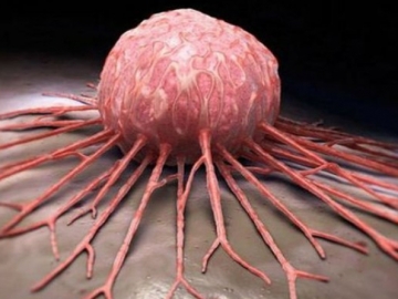 Perlu Diwaspadai, 8 Aktivitas Ini Bisa Jadi Pemicu Kanker