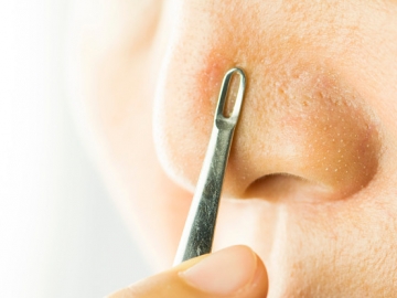 7 Bahan Alami yang Dapat Menghilangkan Komedo di Hidung dengan Cepat