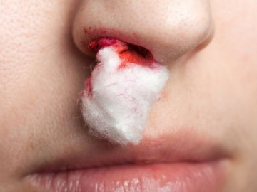 Waspada, Ini 7 Penyebab Umum Mimisan Pada Anak dan Orang Dewasa 