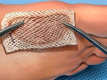 Tips Mengobati Luka Penderita Diabetes yang Susah Sembuh