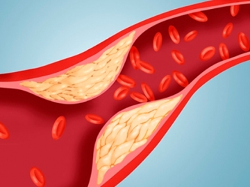 Ketahui 8 Pantangan dan Makanan yang Baik Bagi Penderita Kolesterol Tinggi