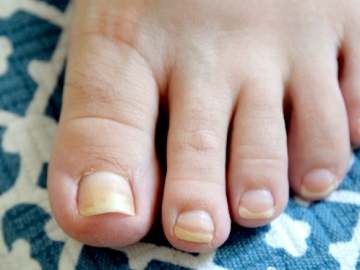 Kuku Rusak dan Kuning Akibat Jamur? Gunakan 7 Bahan Alami Ini Untuk Mengatasinya