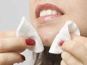 Sering Memencet Jerawat Sembarangan? Kenali Bahaya yang Dapat Terjadi Hingga Sebabkan Kematian