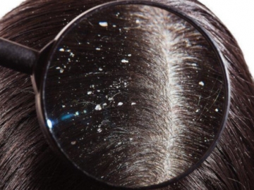 Sederet Bahan Alami yang dapat Membasmi Ketombe Membandel