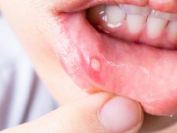 Ketahui 7 Bahan Alami yang Manjur Mengobati Sariawan