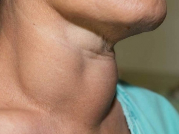 Sering Disangka Flu, Ini Sederet Tanda Kanker Tiroid yang Paling Mudah Dikenali