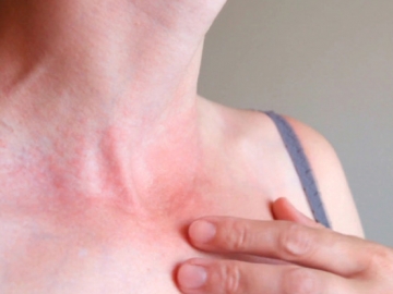 7 Bahan Alami yang dapat Dimanfaatkan untuk Mengatasi Gatal-Gatal di Kulit