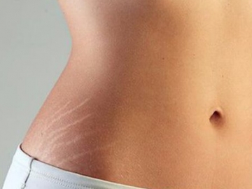 7 Tips Mengatasi Stretch Mark yang Kerap Bikin Tak Percaya Diri