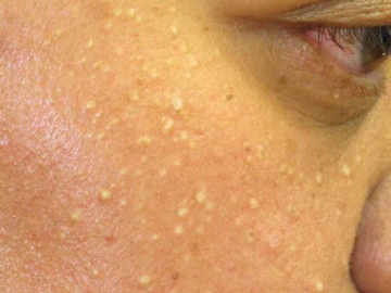 7 Cara Natural Mengatasi Milia di Wajah yang Mengganggu