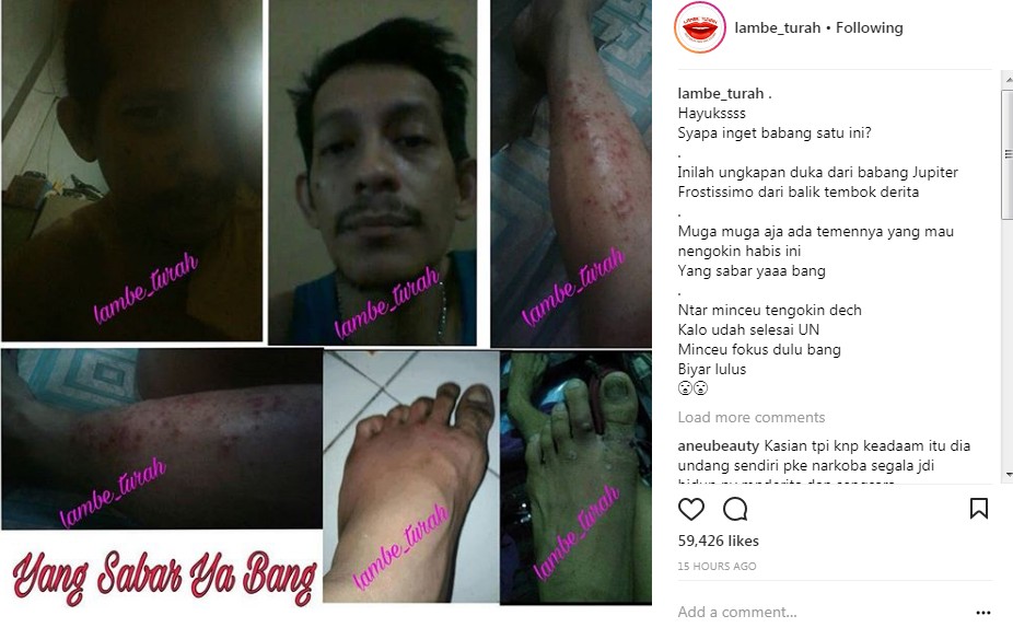 Penyakit Kulit yang Diduga Diderita Jupiter Fortissimo