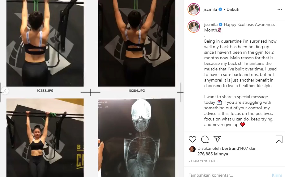 Unjuk Punggung Mulus, Jessica Mila Akui Idap Skoliosis Banjir Dukungan Rekan Artis