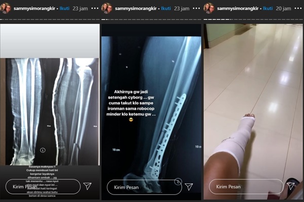 Bagikan Penampakan Tulang Kakinya Usai Dipasang Pen, Sammy Simorangkir: Takut Ironman Minder