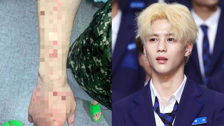 Tangan Penuh Luka dan Goresan, Baek Jin Eks Kontestan \'Produce X 101\' Bikin Cemas