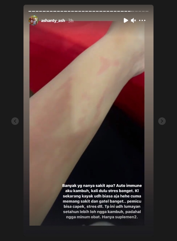 Alami Merah Ruam di Bagian Tubuh, Ashanty Ungkap Penyakit Autoimunnya Kambuh dan Sampaikan Pesan Ini