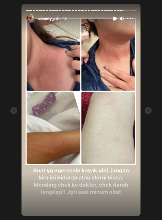 Alami Merah Ruam di Bagian Tubuh, Ashanty Ungkap Penyakit Autoimunnya Kambuh dan Sampaikan Pesan Ini