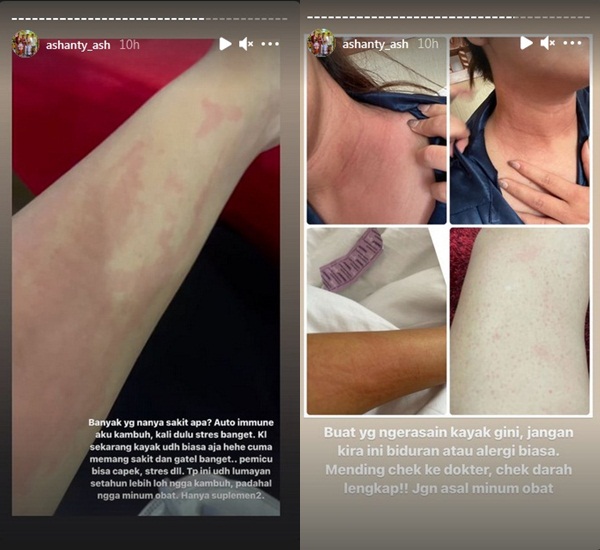 Sudah Setahun Tak Kambuh, Ashanty Ungkap Kondisi Terkini Idap Autoimun