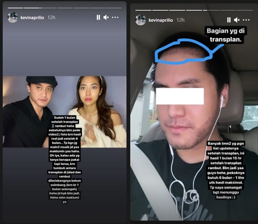Kevin Aprilio Tunjukkan Penampilan Terbaru 1,5 Bulan Setelah Transplantasi Rambut, Akui Belum Pede