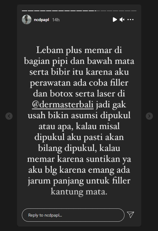 Wajah Lebam Diduga Kena Pukul, Nora Alexandra Bongkar Faktanya