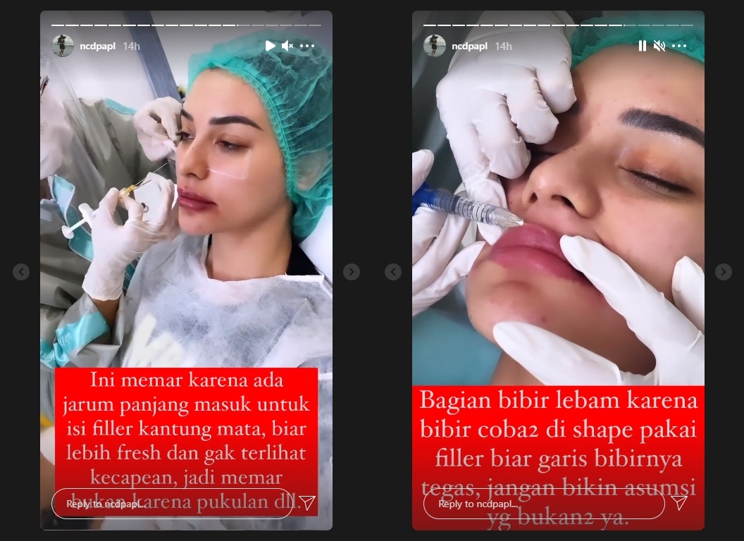Wajah Lebam Diduga Kena Pukul, Nora Alexandra Bongkar Faktanya